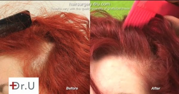 traction-alopecia-left-side-female- Dr U Hair And Skin Clinic