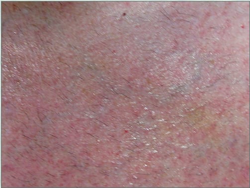 3 hours after surgery FUE wound healing from the DrUGraft procedure has already begun
