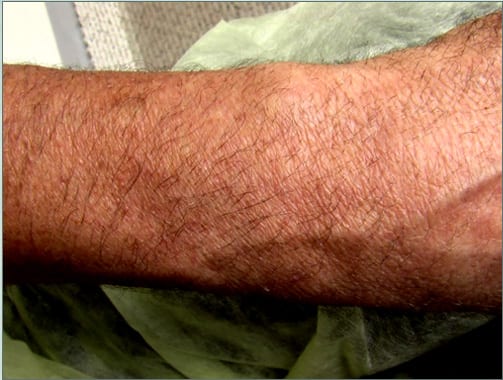 Hyperpigmentation generally subsides after surgery