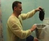 Ditching the hairpiece after hair restoration surgery