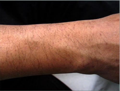 Donor area after hair transplant