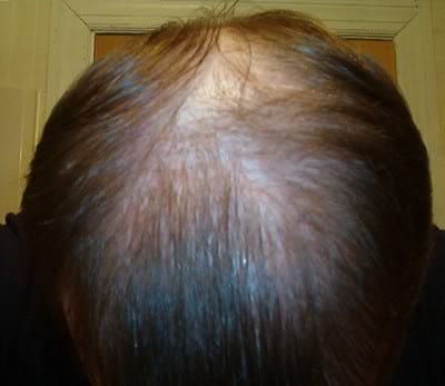 The DrUGraft procedure offers better hair loss solutions than hair loss concealers