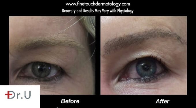 "Brooke Shields" density eyebrow restoration thanks to Dr.UGraft. "Brooke Shields" density eyebrow restoration thanks to Dr.UGraft.