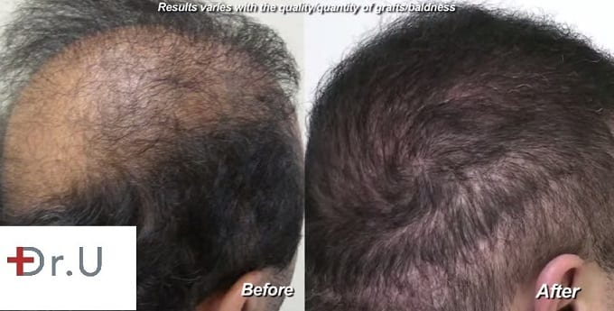 The crown and sides of the hair repaired by Dr. Umar with the Dr.UGraft