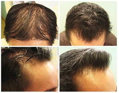 Results of Dr.UGraft Asian FUE hair transplant