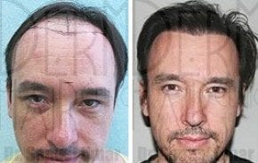 Dr. Umar performed Asian hairline restoration using Dr.UGraft