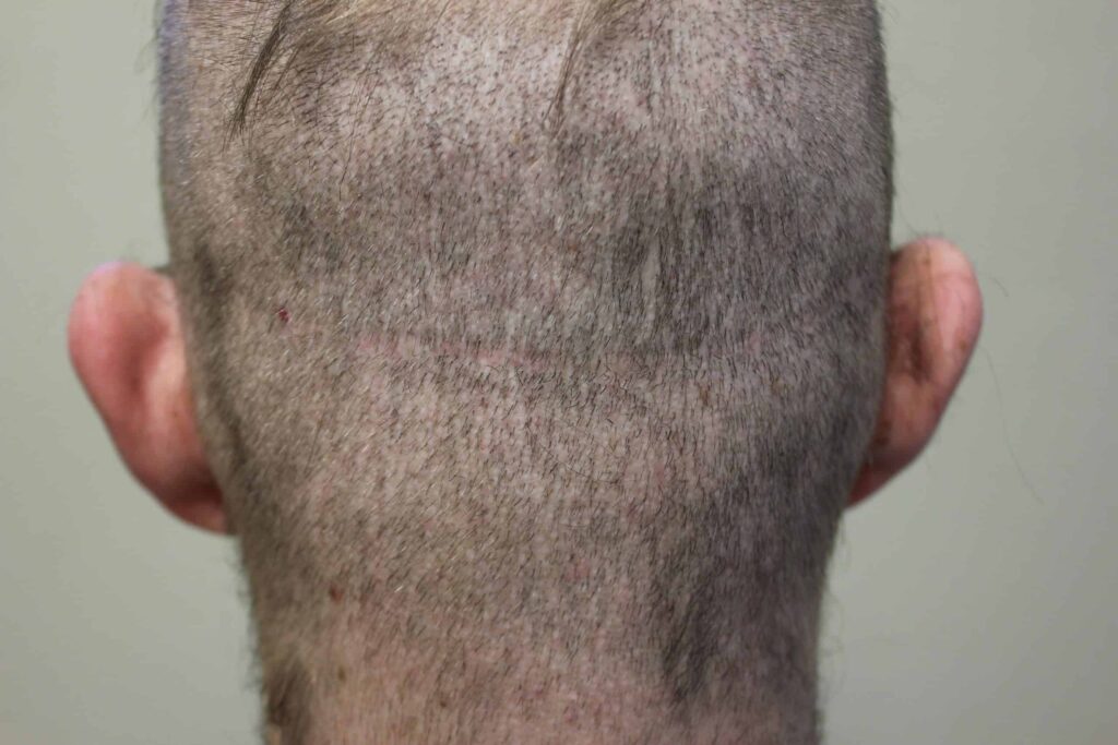 fue white dot scarring in a shaved head vs strip scar in the shaved head of a patient