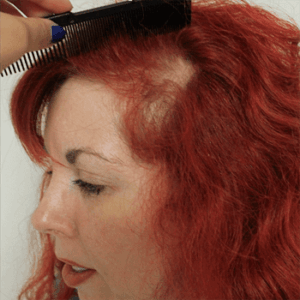Hair Loss Caused by Traction Alopecia - Dr U Hair And Skin Clinic