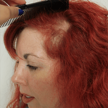 Hair Loss Caused by Traction Alopecia - Dr U Hair And Skin Clinic