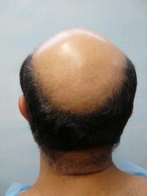 Hair transplant or wigs: Men suffering hair loss often don't know to turn to hair transplant or hair replacement system