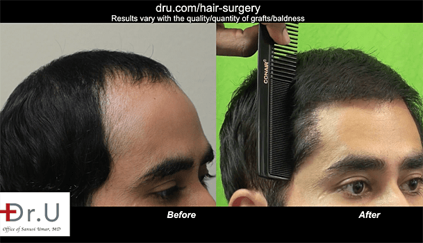 Fix hair loss with body hair transplant: Before and After the Body hair transplant with no visible scarring