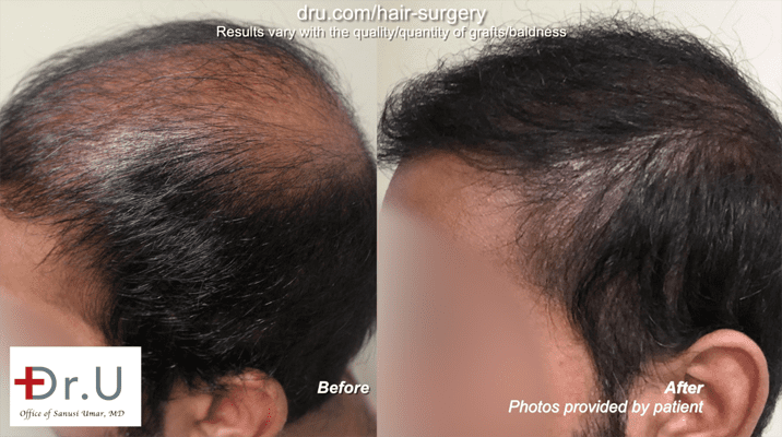 Fix old hair transplants using the DrUGraft BHT system