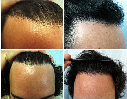 hair transplant consultation process -discussing hair graft types to use for hairline detail