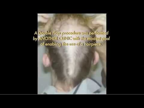 Antiquated Scalp reduction had caused an anatomic deformity of the crown called the "Slot deformity" in this patient