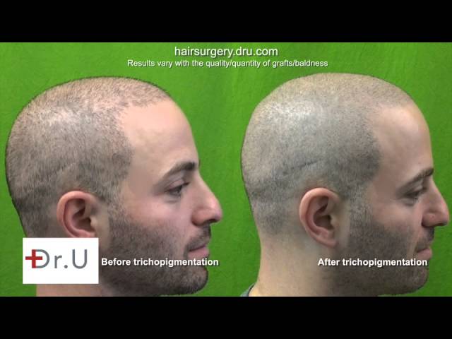 Temporary hair loss solution, scalp tattooing, scalp tattoo for hair loss, scalp micro pigmentation, SMP