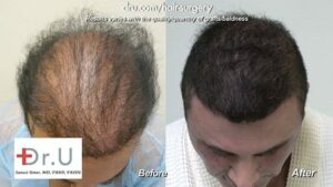 Before and After Patient from Ugraft Body Hair Transplant - Dr U Hair And Skin Clinic