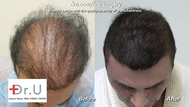 Before and After Patient from Ugraft Body Hair Transplant - Dr U Hair And Skin Clinic