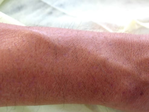 Hair transplant recovery period: redness after surgery