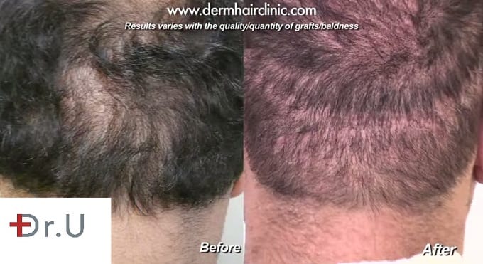 Scar repair using body hair transplant with the Dr.UGraft.