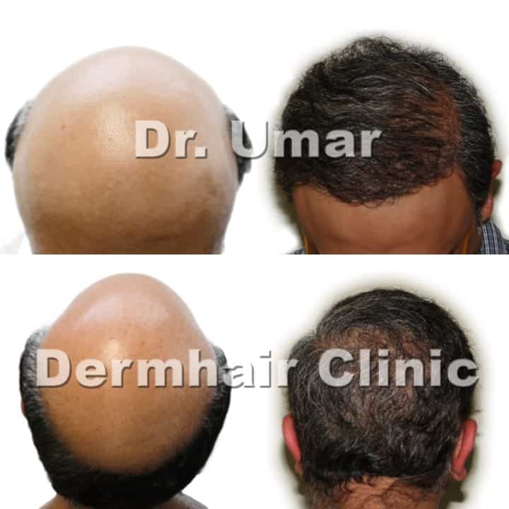 Severe hair loss hair transplant using DrUGraft