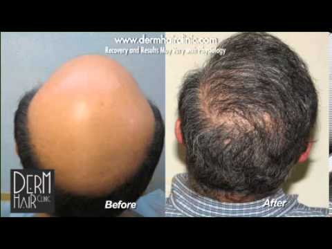 Cost of hair restoration may influenced by many factors such as the severity of hair loss. High graft count Patient with severe baldness before and after 12500 graft Dr UGraft advanced FUE restoration