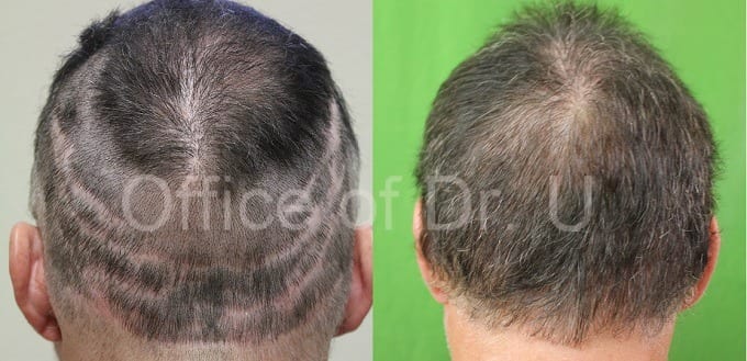 choosing your hair transplant doctor - hair transplant repair for strip scars