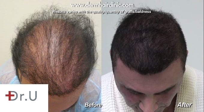 Body hair to head transplant with the Dr UGraft procedure