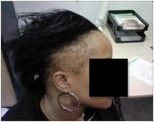Traction alopecia: a cause of hair loss, prominently in women Traction alopecia: a cause of hair loss, prominently in women