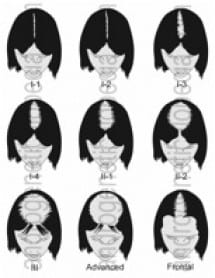 Contrary to popular belief, women do experience hair loss. Female hair transplant offers treatment Contrary to popular belief, women do experience hair loss. Female hair transplant offers treatment