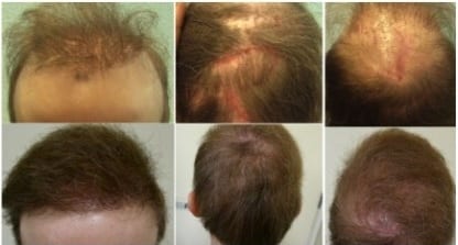 Hair transplant repair with the DrUGraft BHT