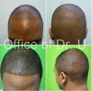 With the advanced FUE by Dr.UGraft patients see real results.