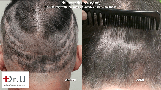 Botched hair transplant pictures: Dr. Umar repaired scarring from several strip surgeries.*