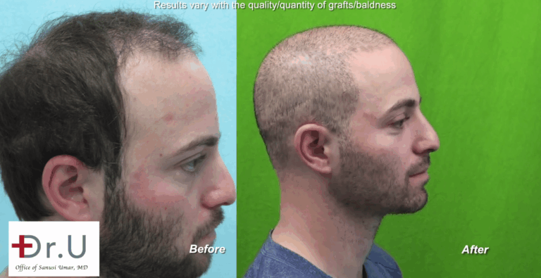 Is there a minimum age for hair transplant ? Dr U says No. This young age hair transplant patient found his solution from Dr.UGraft BHT Hair surgery which fixed his scar and baldness allowing for a buzz cut Is there a minimum age for a hair transplant? Dr U says No. This young age hair transplant patient found his solution from Dr.UGraft BHT Hair surgery which fixed his scar and baldness allowing for a buzz cut*