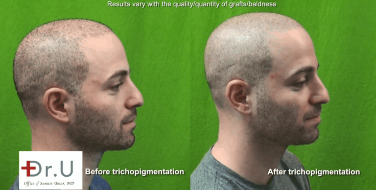 Los Angeles Young Aged Hair Transplant Using Dr. UGraft: Before and After BHT and Scalp Micropigmentation integrated Approach For A Buzz Cut*