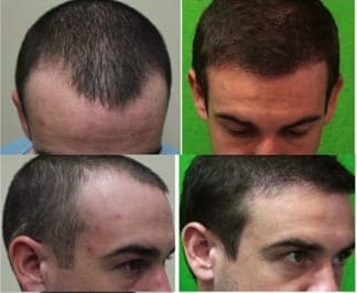 The advanced FUE method has many patients turning to hair transplants for natural looking results.