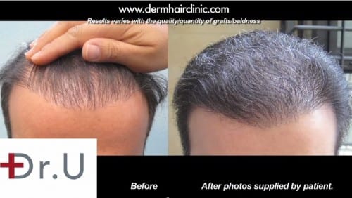 Body hair transplantation with the advanced FUE by Dr.UGraft 