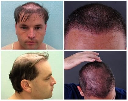 Before seeing Dr. Umar, the patient suffered complications of hair replacement.