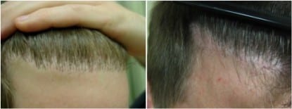 Before and after treatment with the DrUGraft