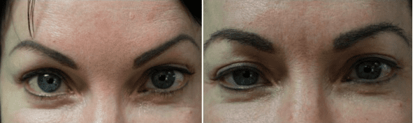 Eyebrow hair restoration: a breakthrough of Dr.UGraft