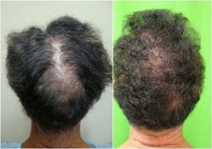 Crown Slot deformity caused by scalp reduction before and after photo, the area is covered using body hair by Dr.UGraft.
