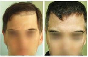 Hair Transplant Gone Bad: Repair with the DrUGraft FUE