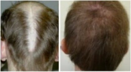 Bad Hair Transplant repair: results of the DrUGraft BHT