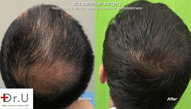 Patient before and after hair restoration