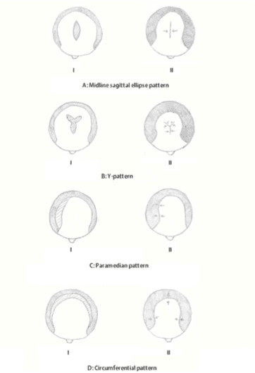 Fixing bad hair transplant results: many of Dr. Umar's patients have undergone scalp reductions with unsatisfying results