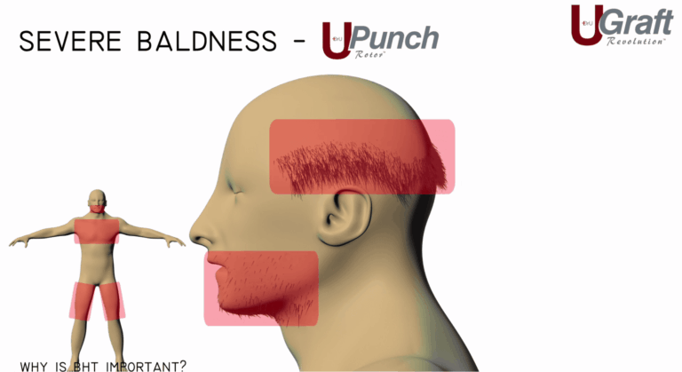 The Dr.UGraft is able to pull hair from the beard and head to create fuller coverage on the top the head. The Dr.UGraft is able to pull hair from the beard and head to create fuller coverage on the top the head.