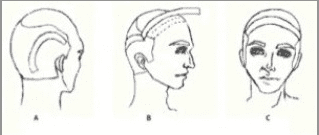 Flap surgery often leaves patients with visible scars