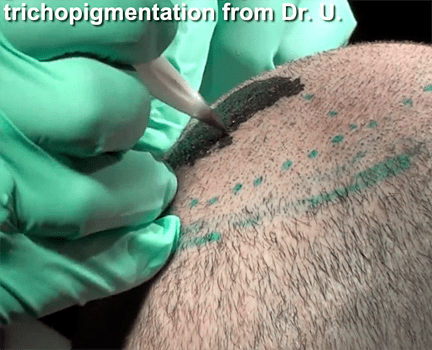 temporary hair loss solution, scalp tattooing, scalp tattoo for hair loss, scalp micropigmentation, Dr. U, 