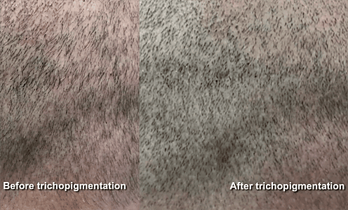 temporary hair loss solution, scalp tattooing, scalp tattoo for hair loss, scalp micropigmentation, 