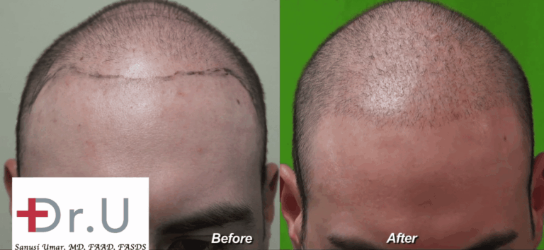 Los Angeles Young Adult Hair Transplant Using Dr. UGraft: Before and After a Less Is More Approach for a Low Budget Hair Transplant Los Angeles Young Adult Hair Transplant Using Dr.UGraft: Before and After a Less Is More Approach for a Low Budget Hair Transplant*