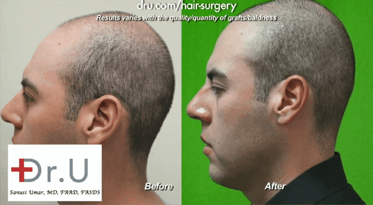 Best Age for a hair transplant: Dr.UGraft Method used by Dr U eliminates the need for defining a hair transplant age limit as discovered by this young adult Los Angeles patient*